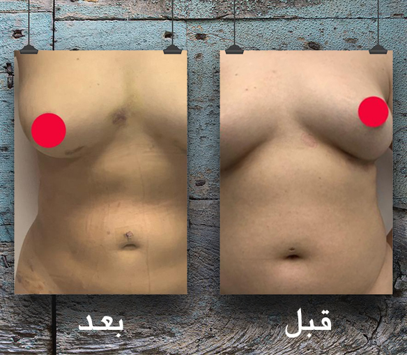 طريقه لتكبير الثدي